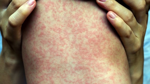 4-more-measles-cases,-1-new-exposure-site-confirmed-in-manitoba