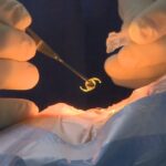 11th-hour-funding-keeps-new-saint-john-area-cataract-clinic-operating