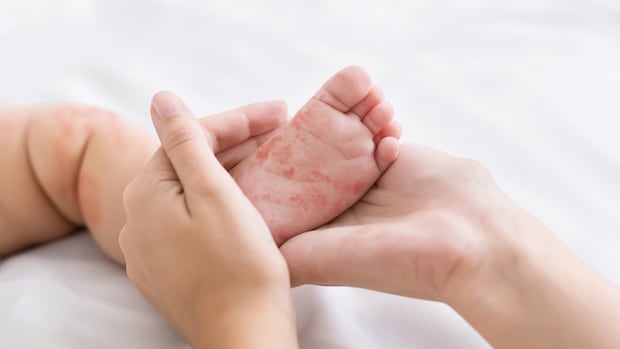 public-health-warns-of-measles-exposures-at-church,-arena-in-southern-manitoba