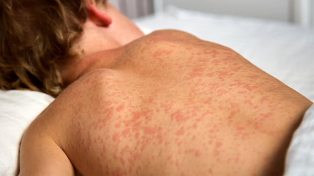 8-more-confirmed-manitoba-measles-cases-reported-in-1st-week-of-december