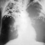 more-tuberculosis-cases-detected-in-nunavut-due-to-increased-screening:-gn