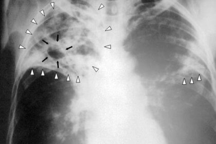more-tuberculosis-cases-detected-in-nunavut-due-to-increased-screening:-gn
