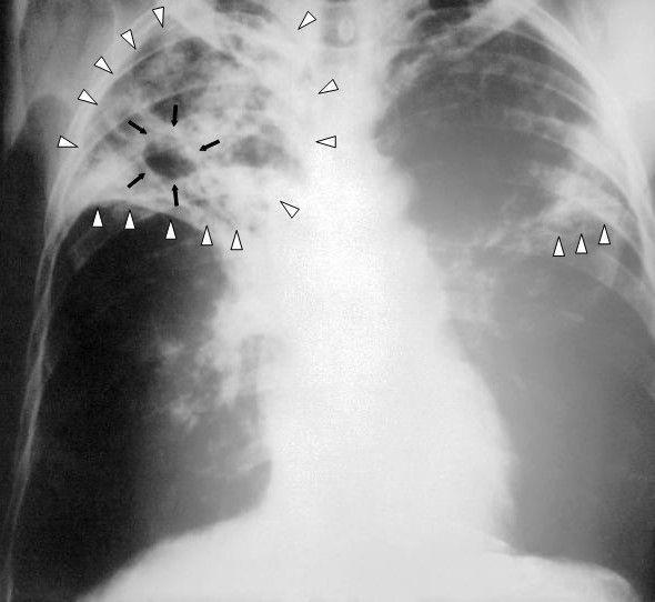 more-tuberculosis-cases-detected-in-nunavut-due-to-increased-screening:-gn